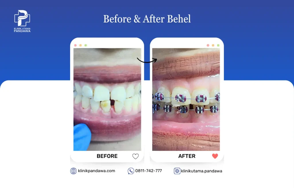 Before and after behel gigi