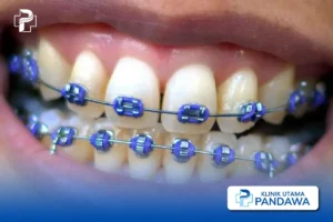 perbedaan behel fashion dan perawatan