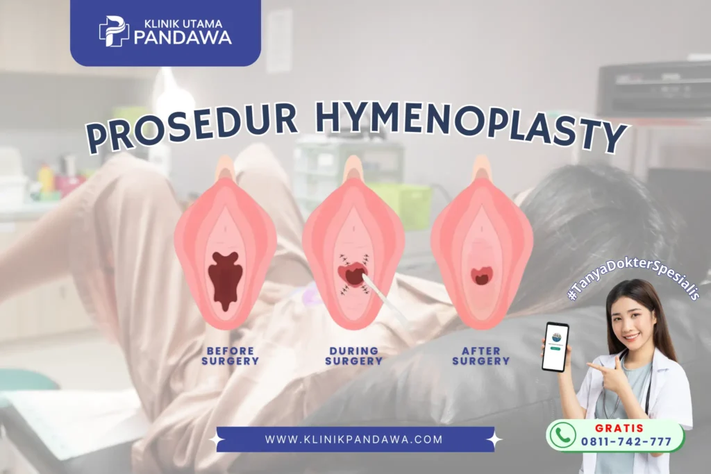 Infografis Proses Hymenoplasty Klinik Utama Pandawa