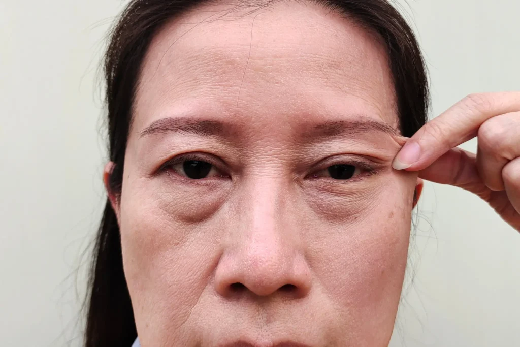 Operasi Kelopak Mata Ptosis