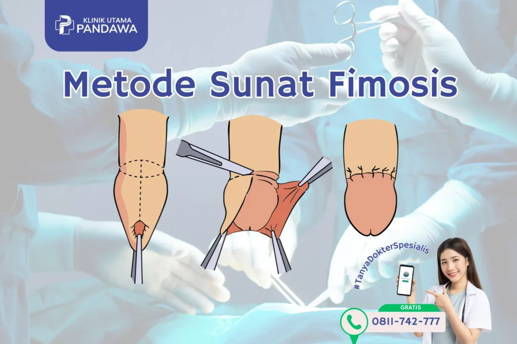 metode sunat untuk fimosis
