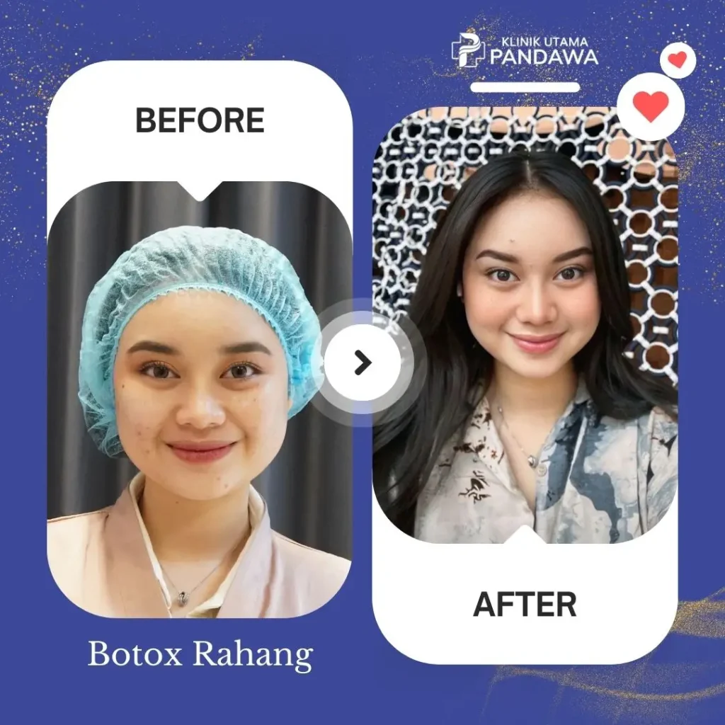 Before After Botox Rahang - Klinik Utama Pandawa