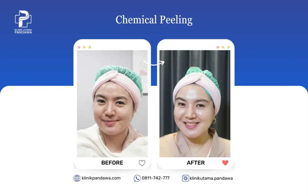 Before After Chemical Peeling 1