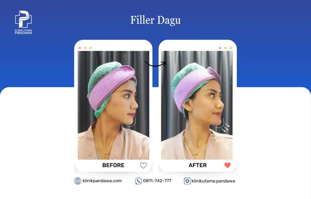 Filler Dagu Klinik Pandawa