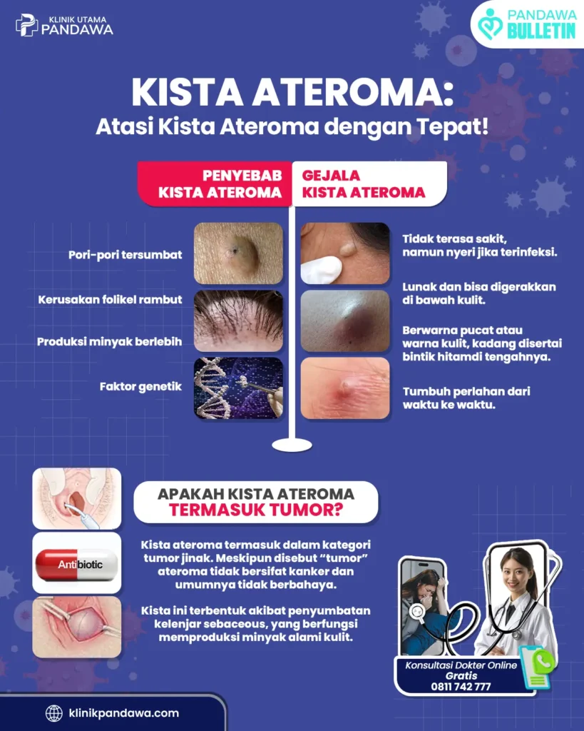 Infografis kista ateroma klinik pandawa