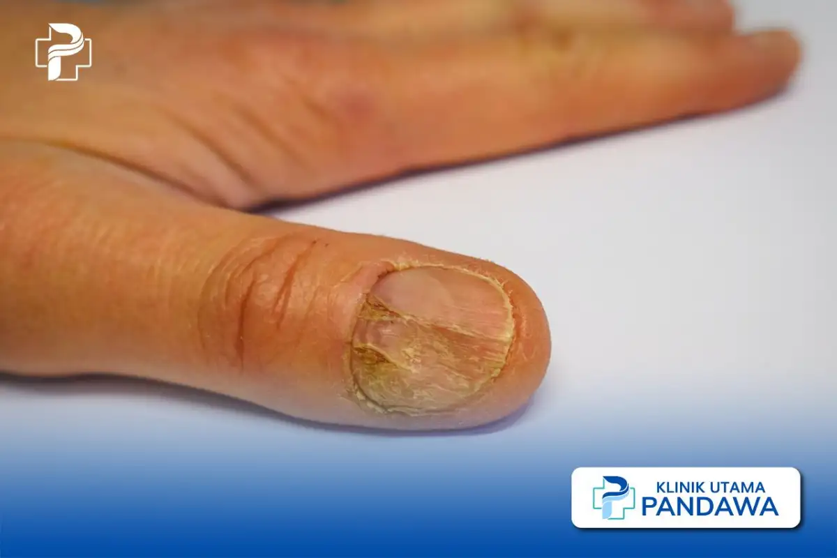 psoriasis kuku