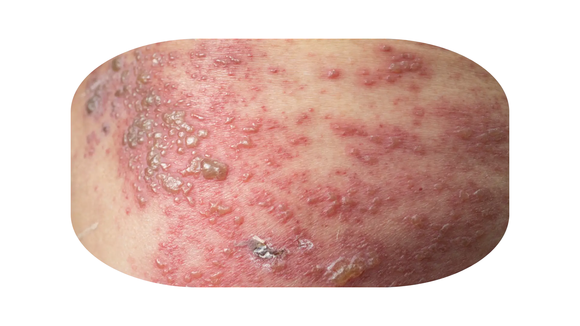 gejala herpes zoster 1