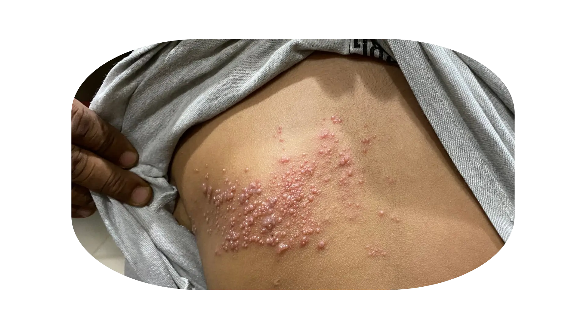 gejala herpes zoster 2