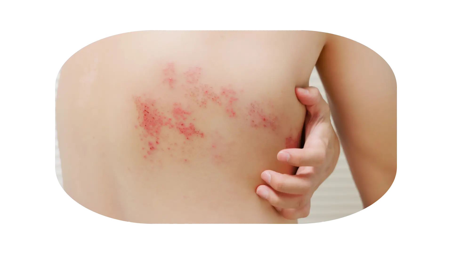 gejala herpes zoster