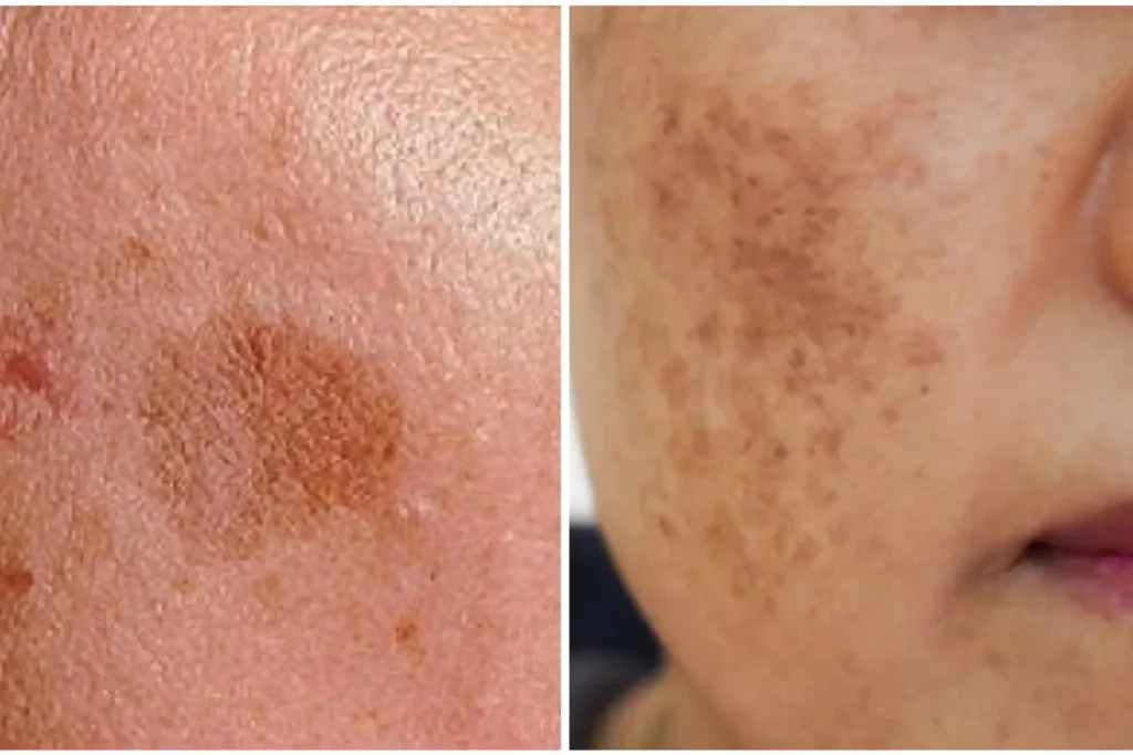 perbedaan lentigo dan melasma