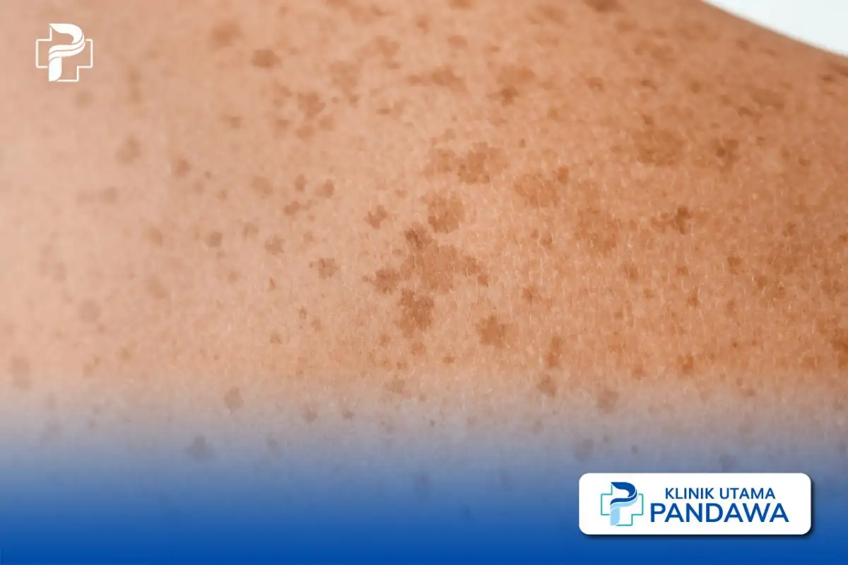 perbedaan lentigo dan melasma