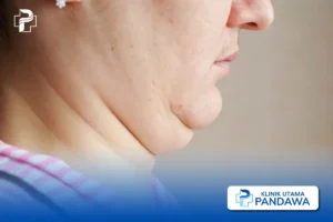 cara menghilangkan double chin