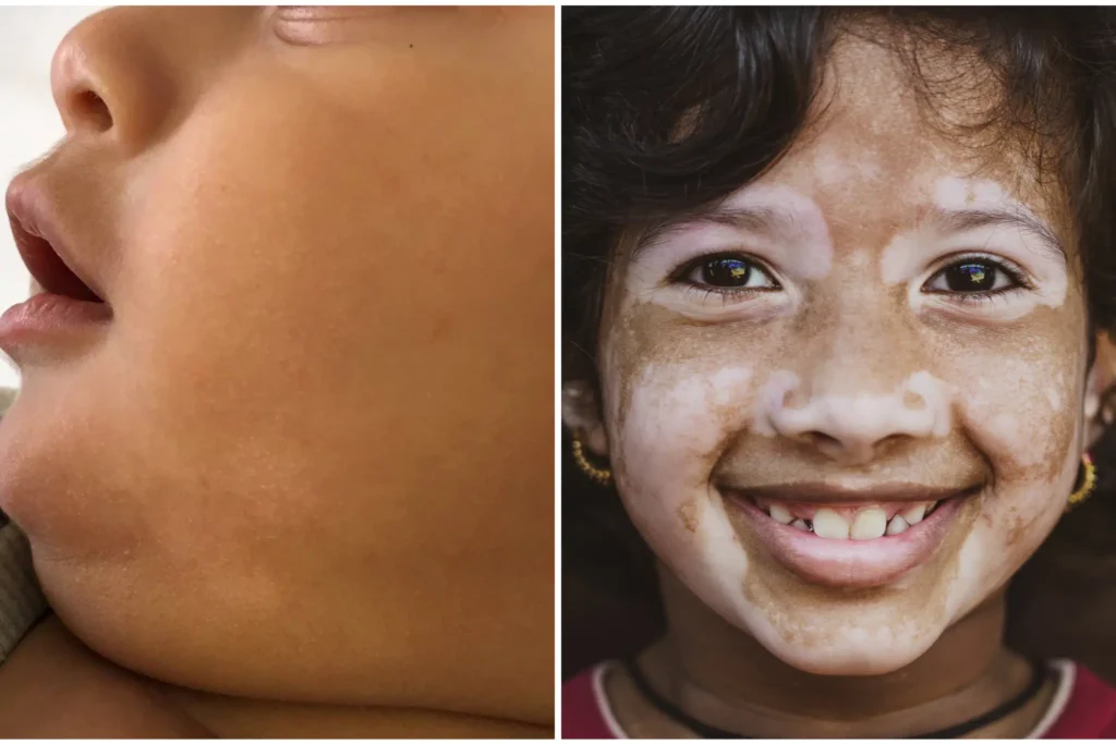 cara menghilangkan pityriasis