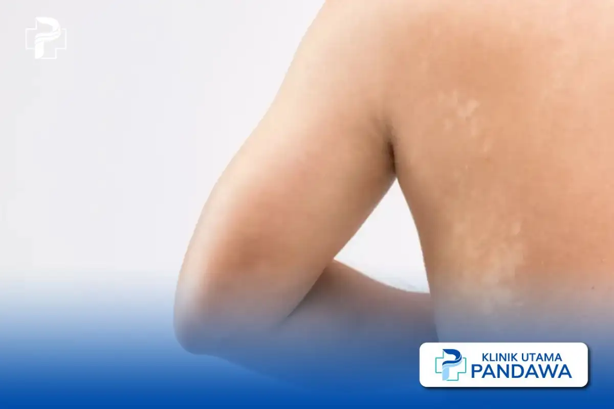 cara menghilangkan pityriasis alba