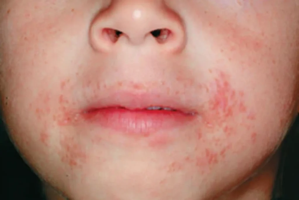 dermatitis perioral