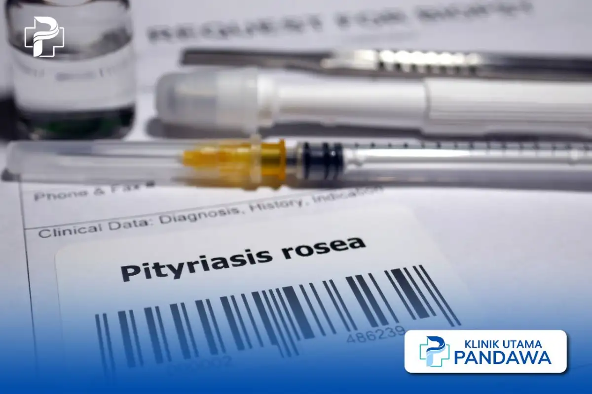 pengobatan pityriasis rosea