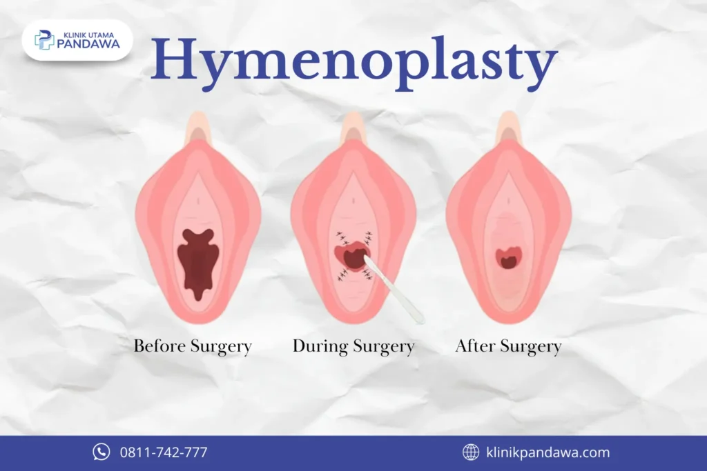 Proses Hymenoplasty Klinik Utama Pandawa