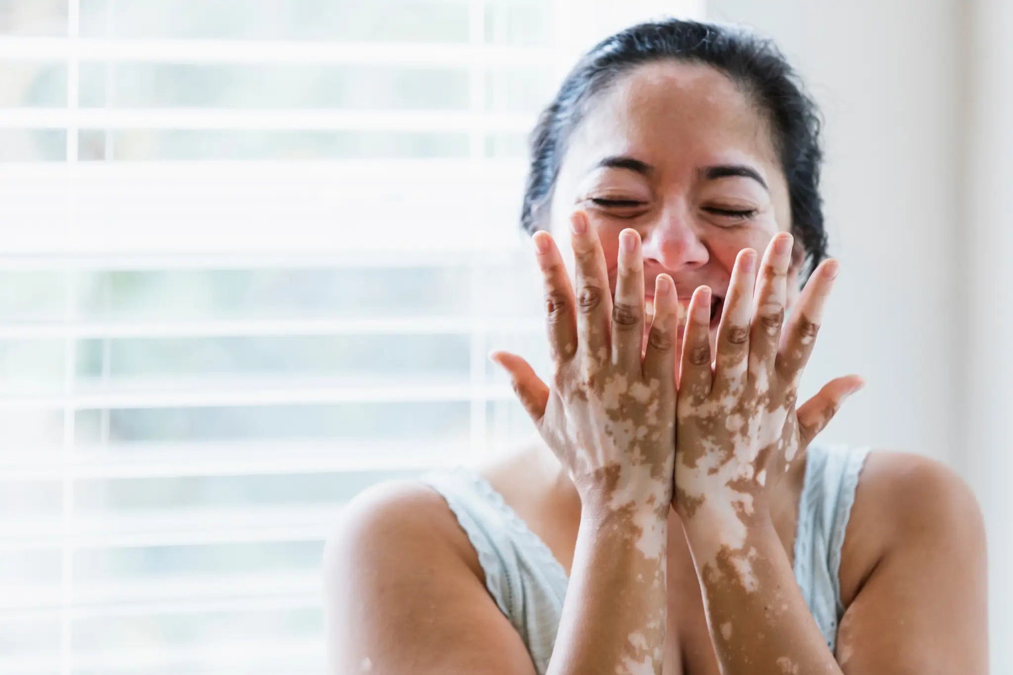 vitiligo adalah
