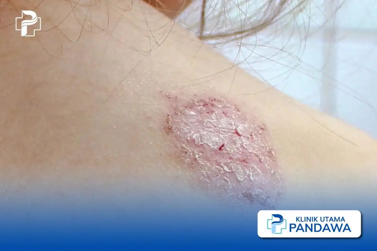 dermatitis numularis