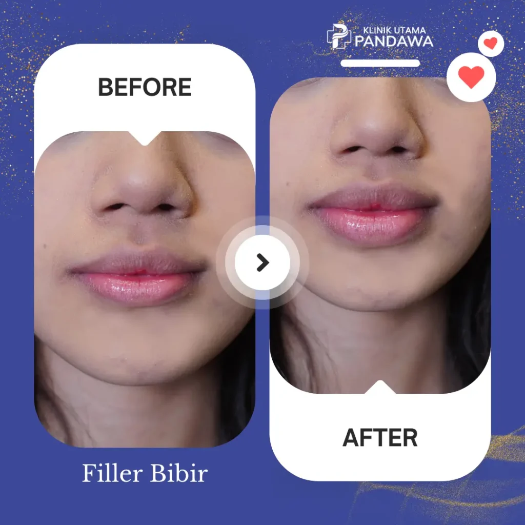 Filler Bibir Before After