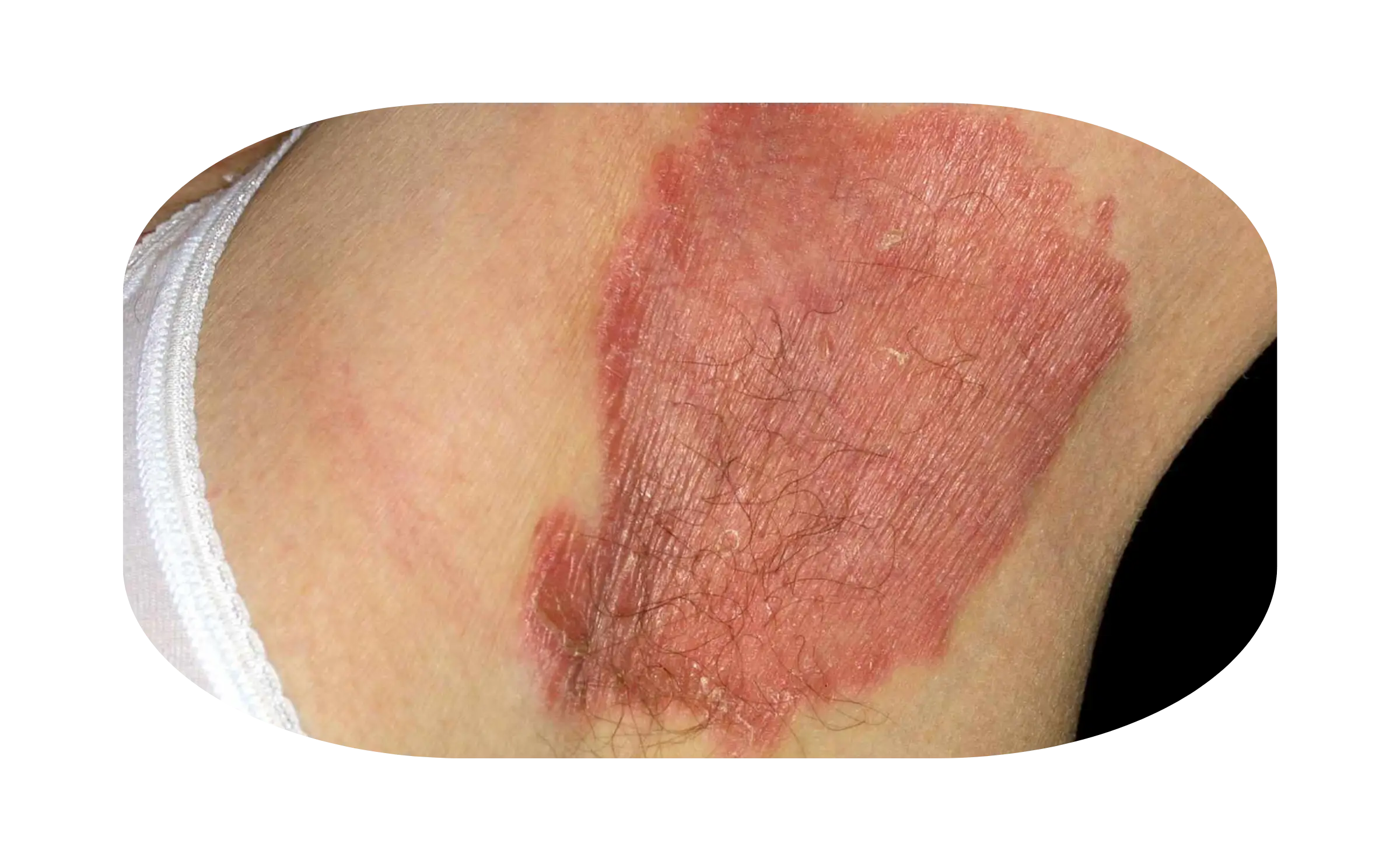 Flexural psoriasis