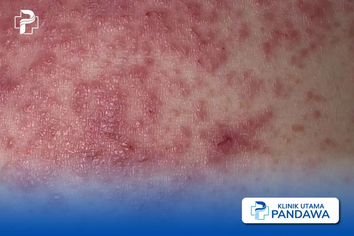 dermatitis herpetiformis