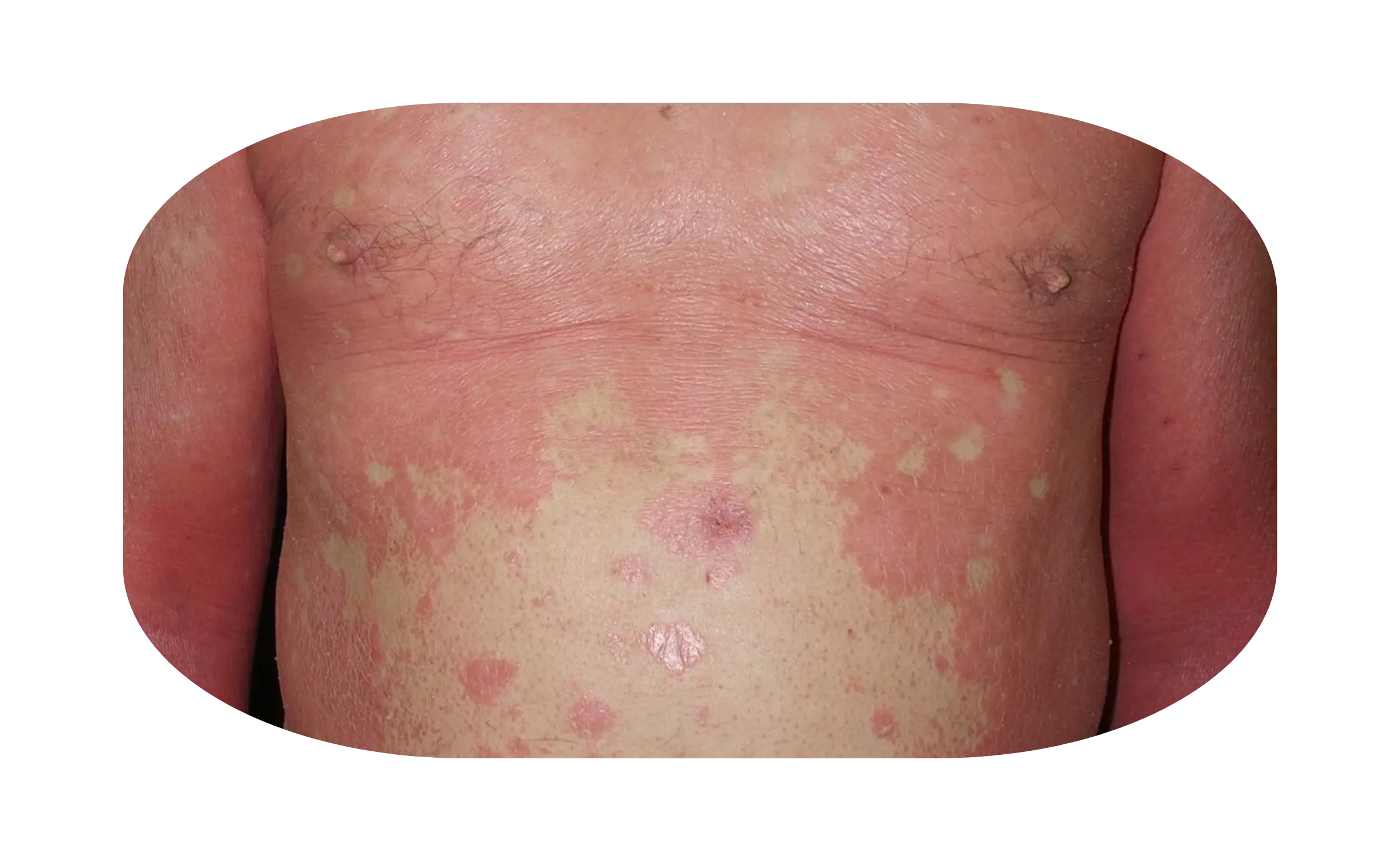 erythrodermic