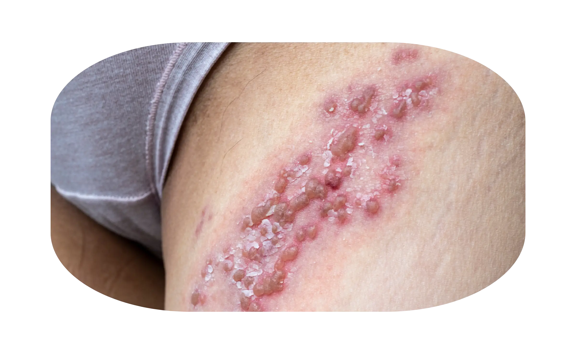 gejala herpes kelamin 1