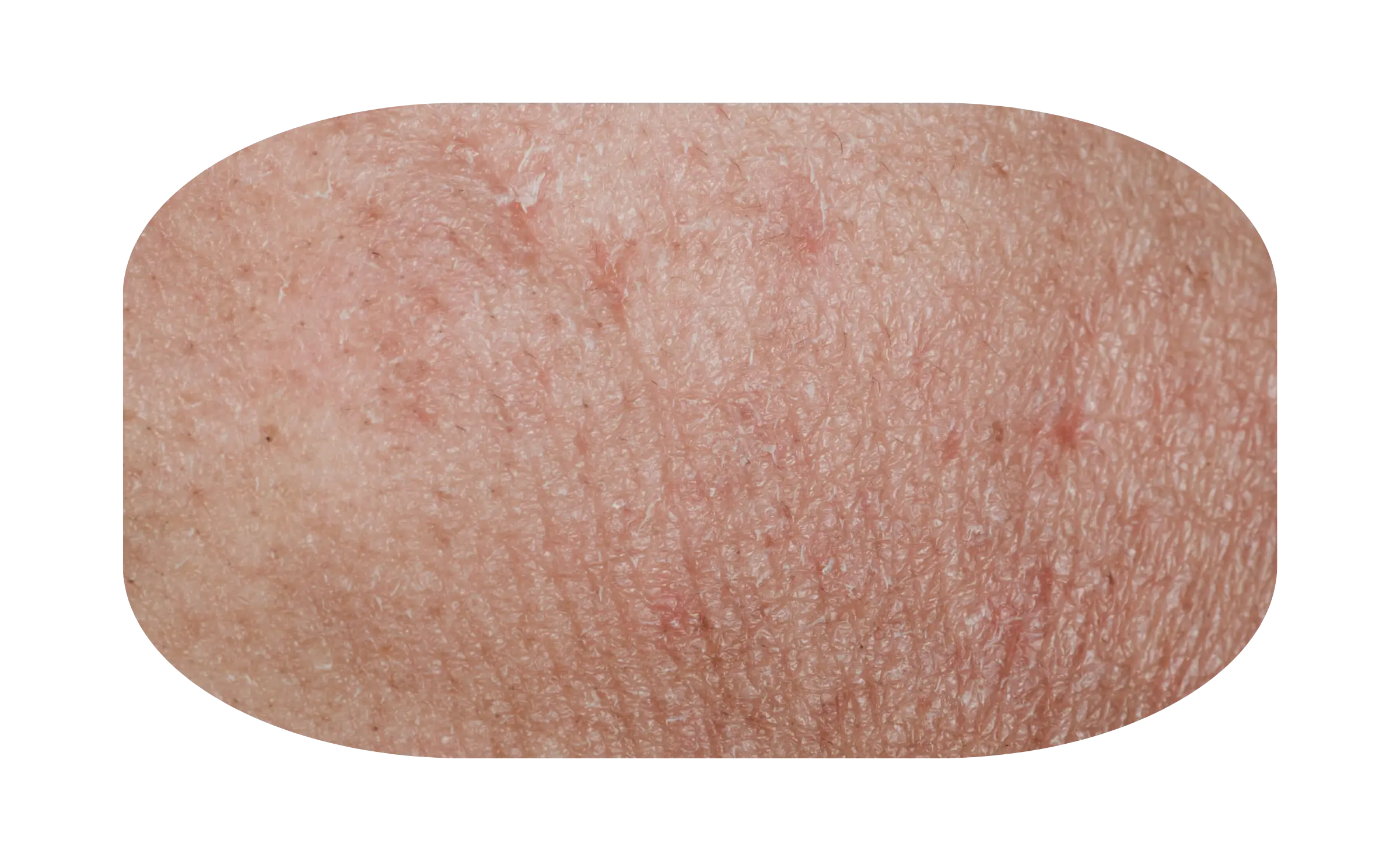 gejala psoriasis 1