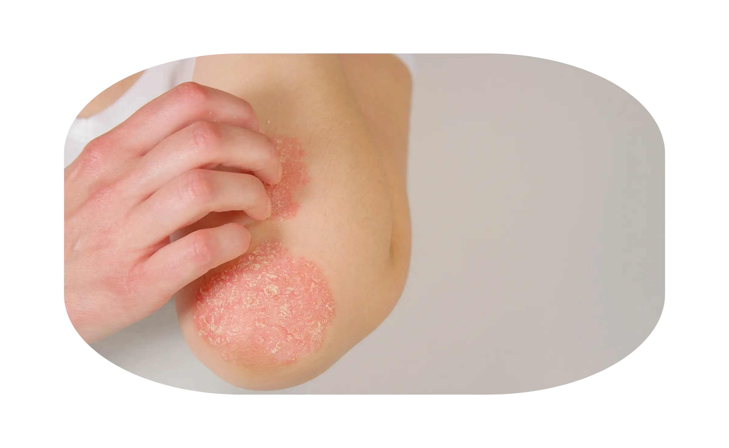 gejala psoriasis 2