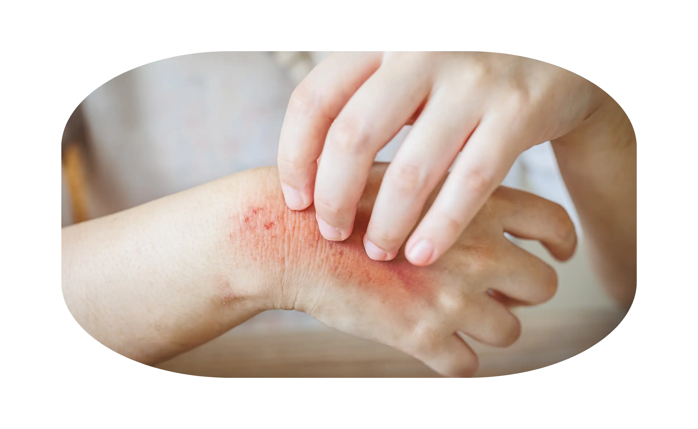 gejala psoriasis