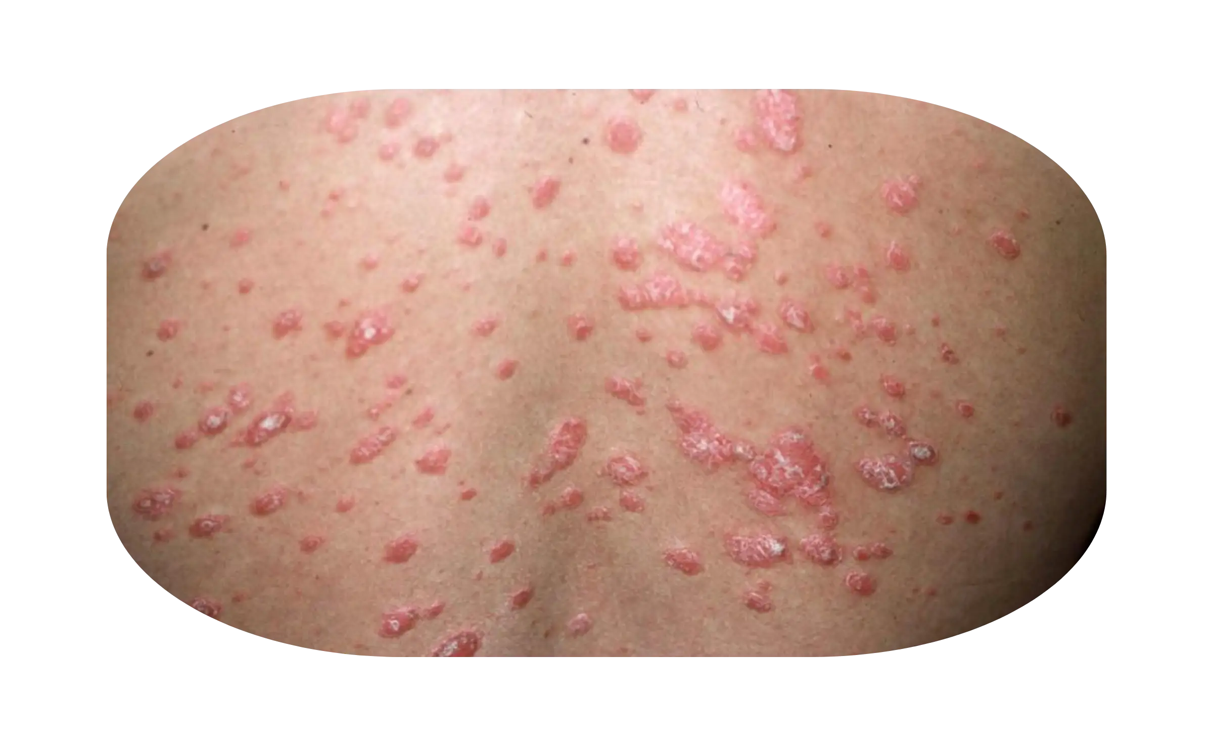 guttate psoriasis