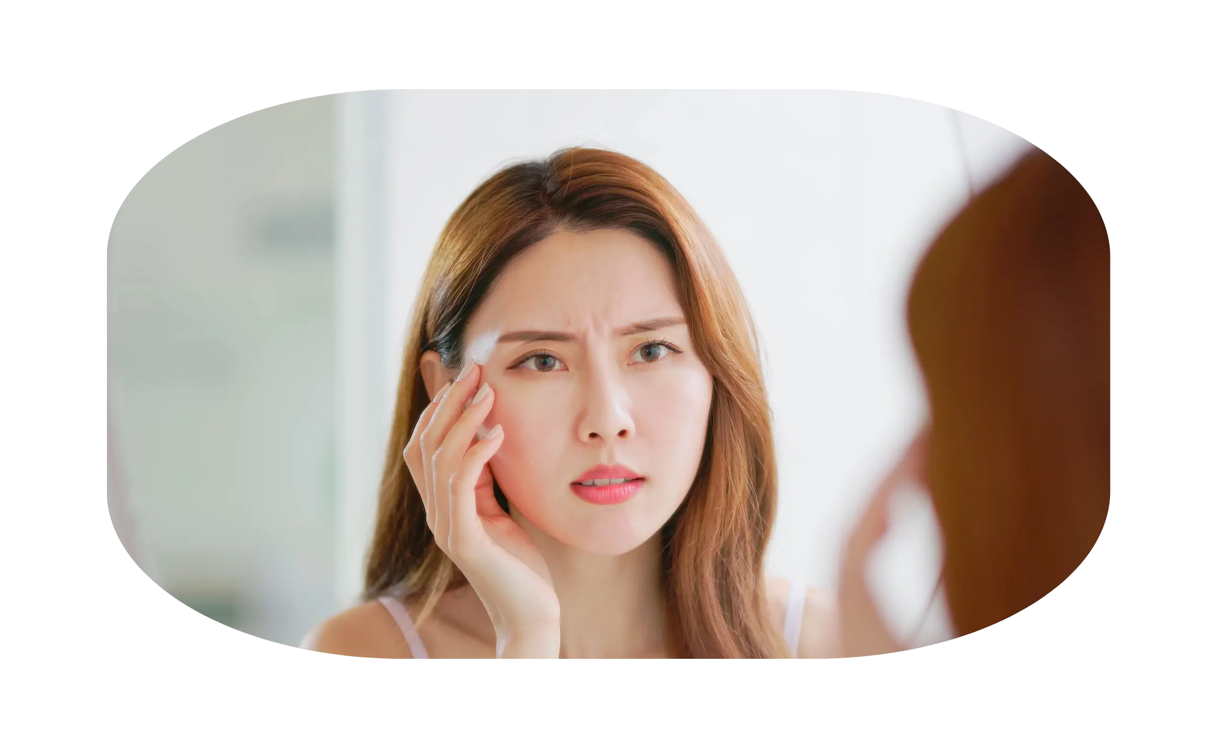 indikasi treatment chemical peeling 2