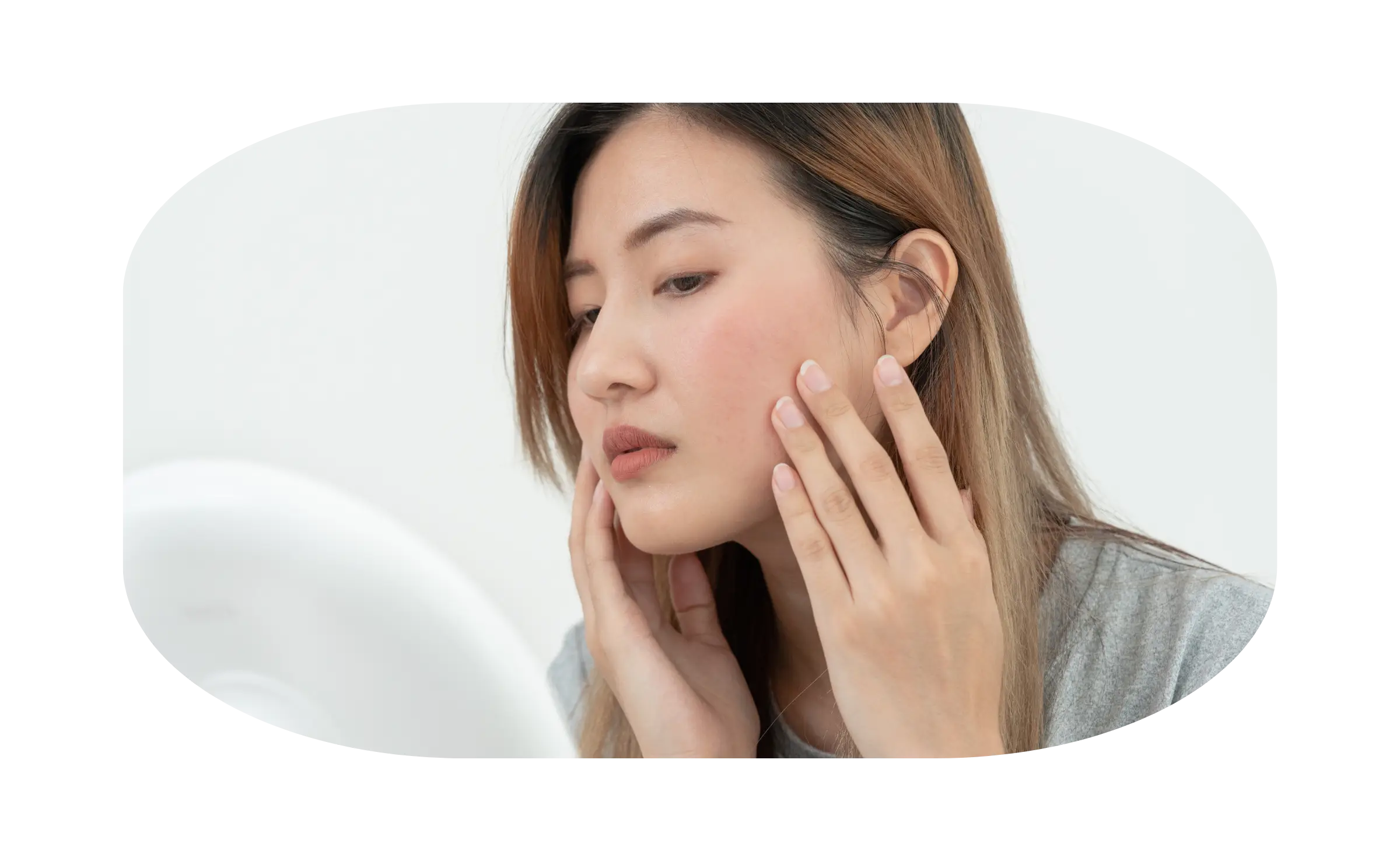 indikasi treatment chemical peeling