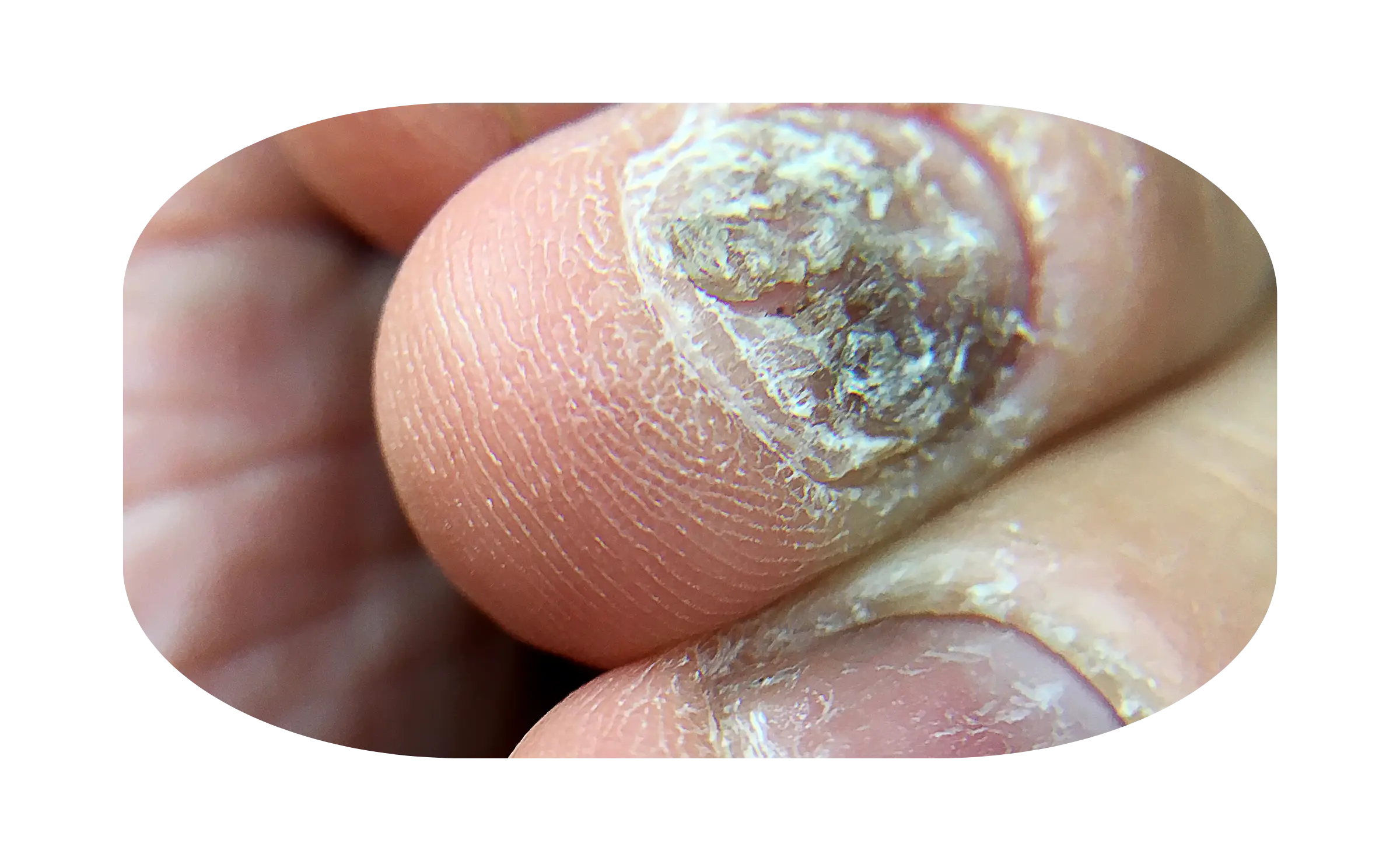 nail psoriasis
