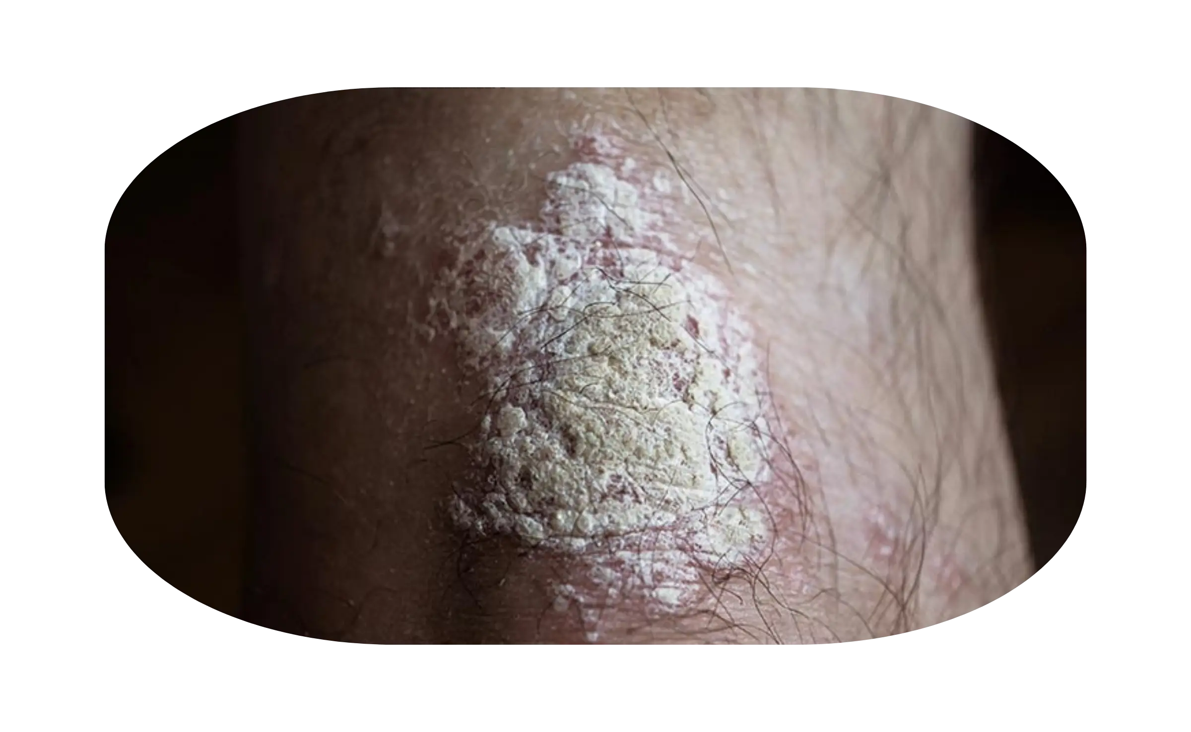 plaque psoriasis