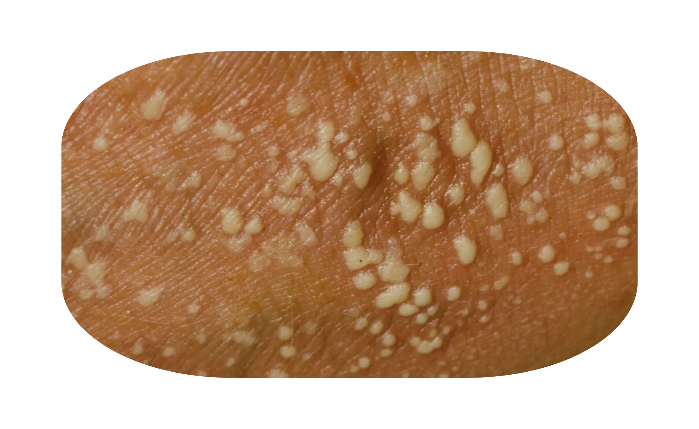 pustular psoriasis