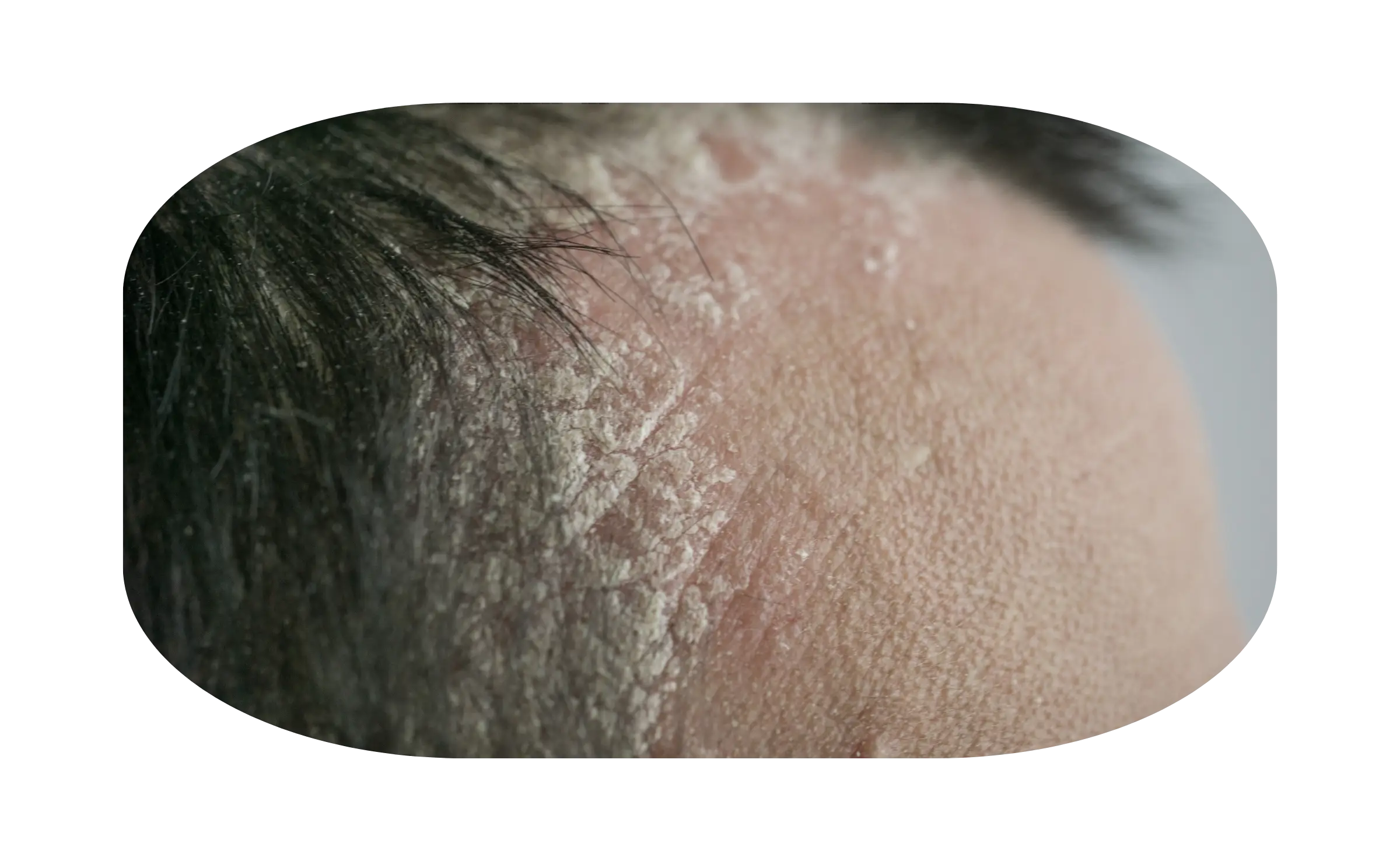 scalp psoriasis
