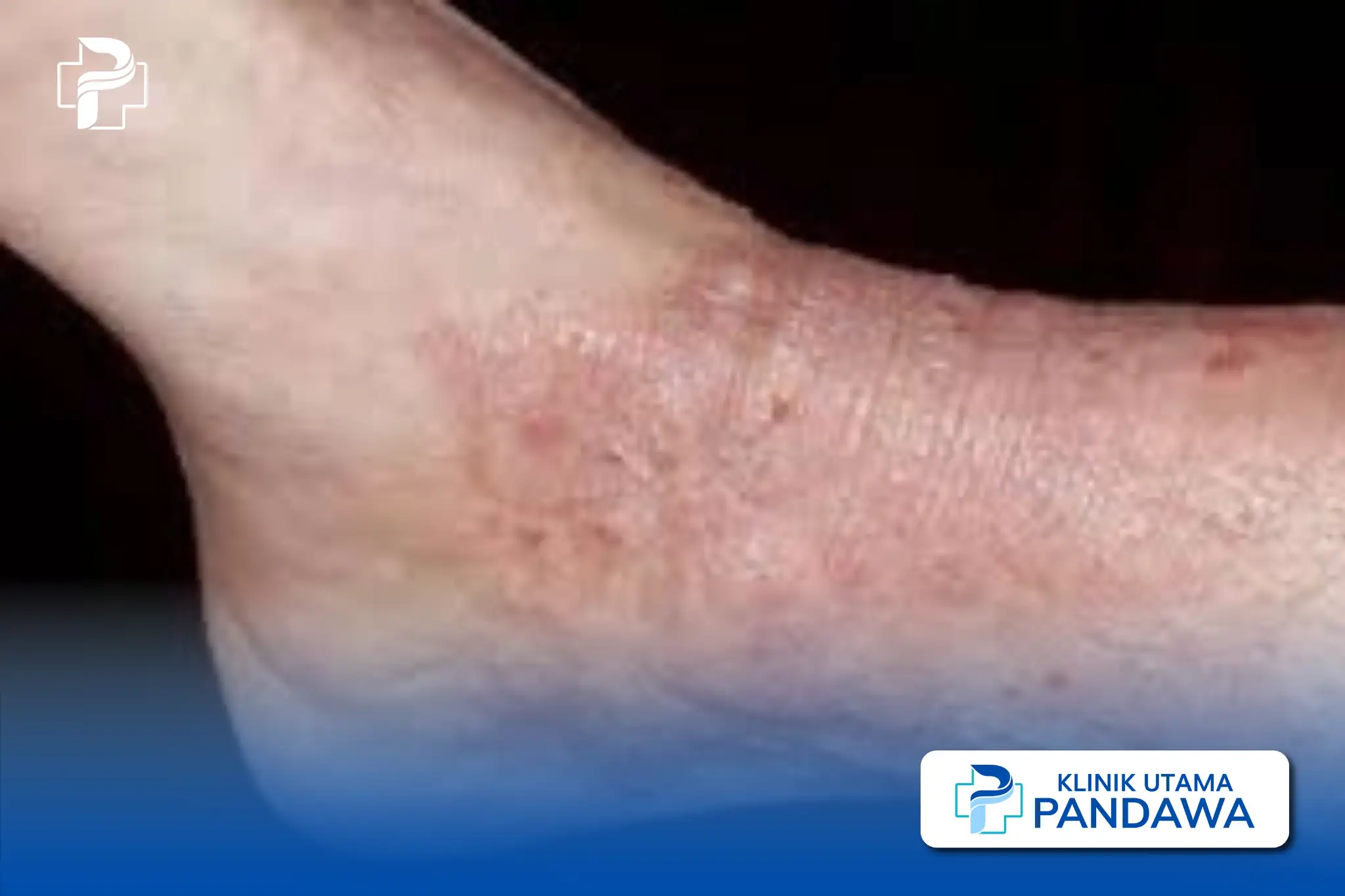 Neurodermatitis