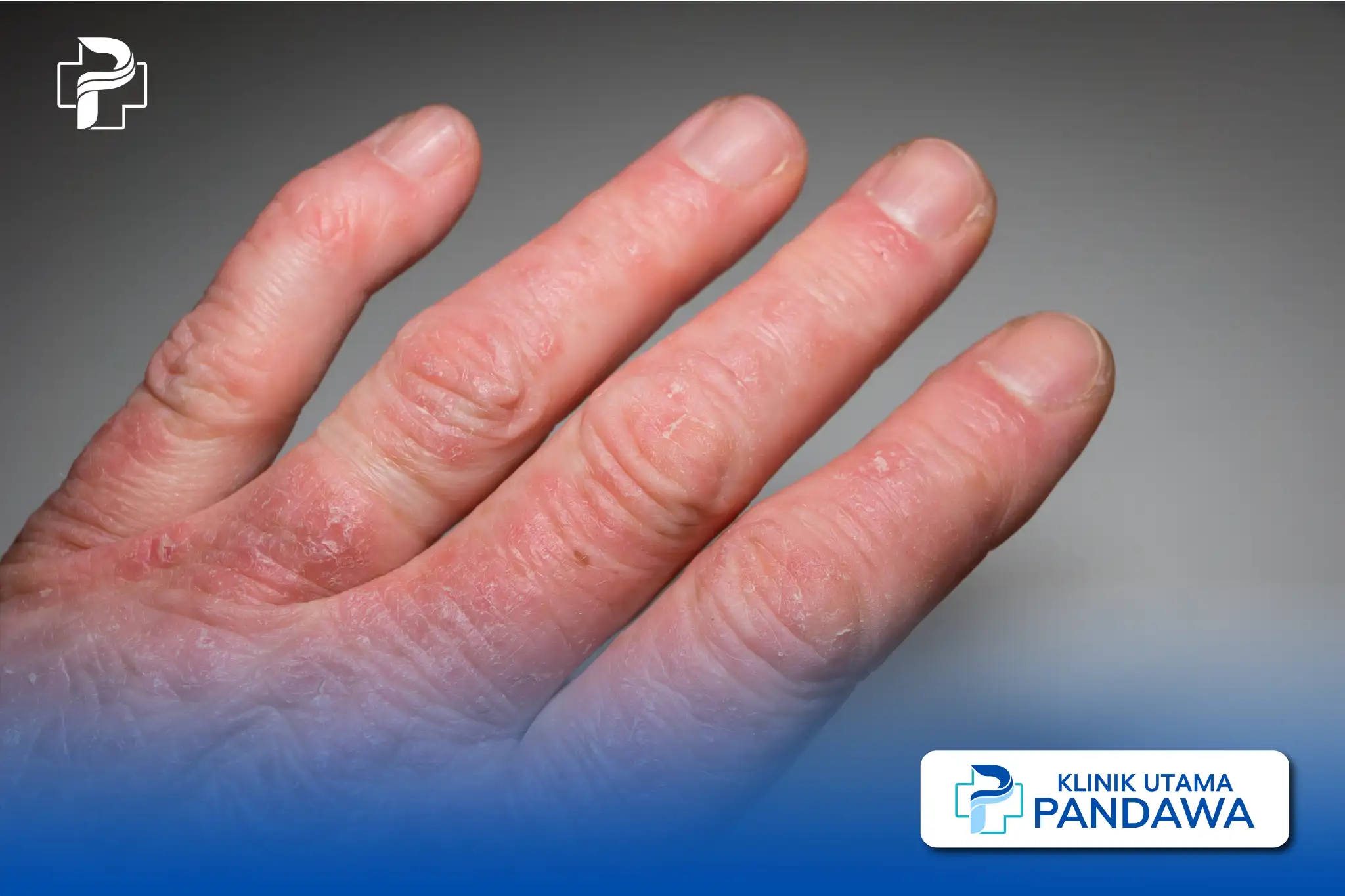 Psoriasis Arthritis