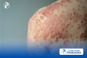 Psoriasis Eritroderma