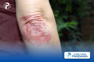 Psoriasis Plak