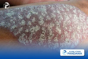 Psoriasis Pustular