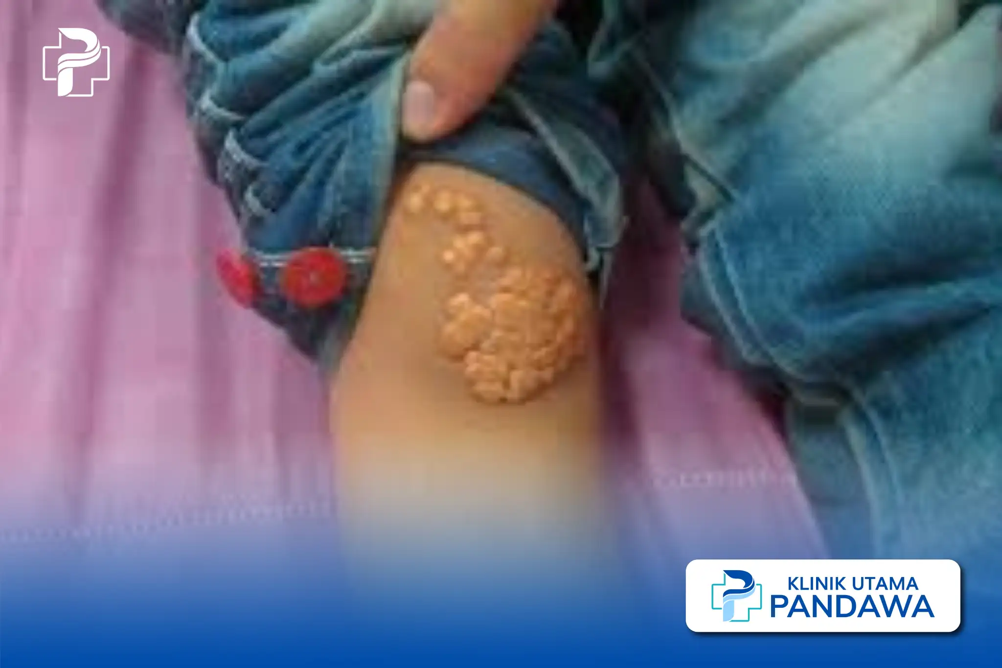 Xanthoma