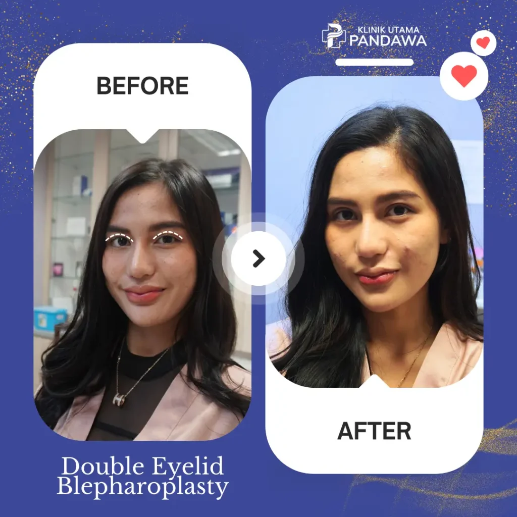 before after bedah blefaroplasty 1