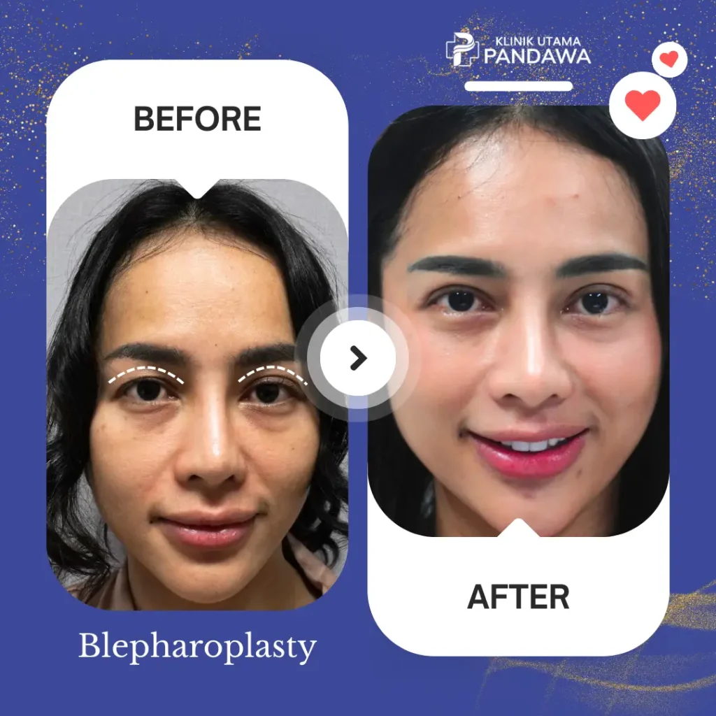 before after bedah blefaroplasty