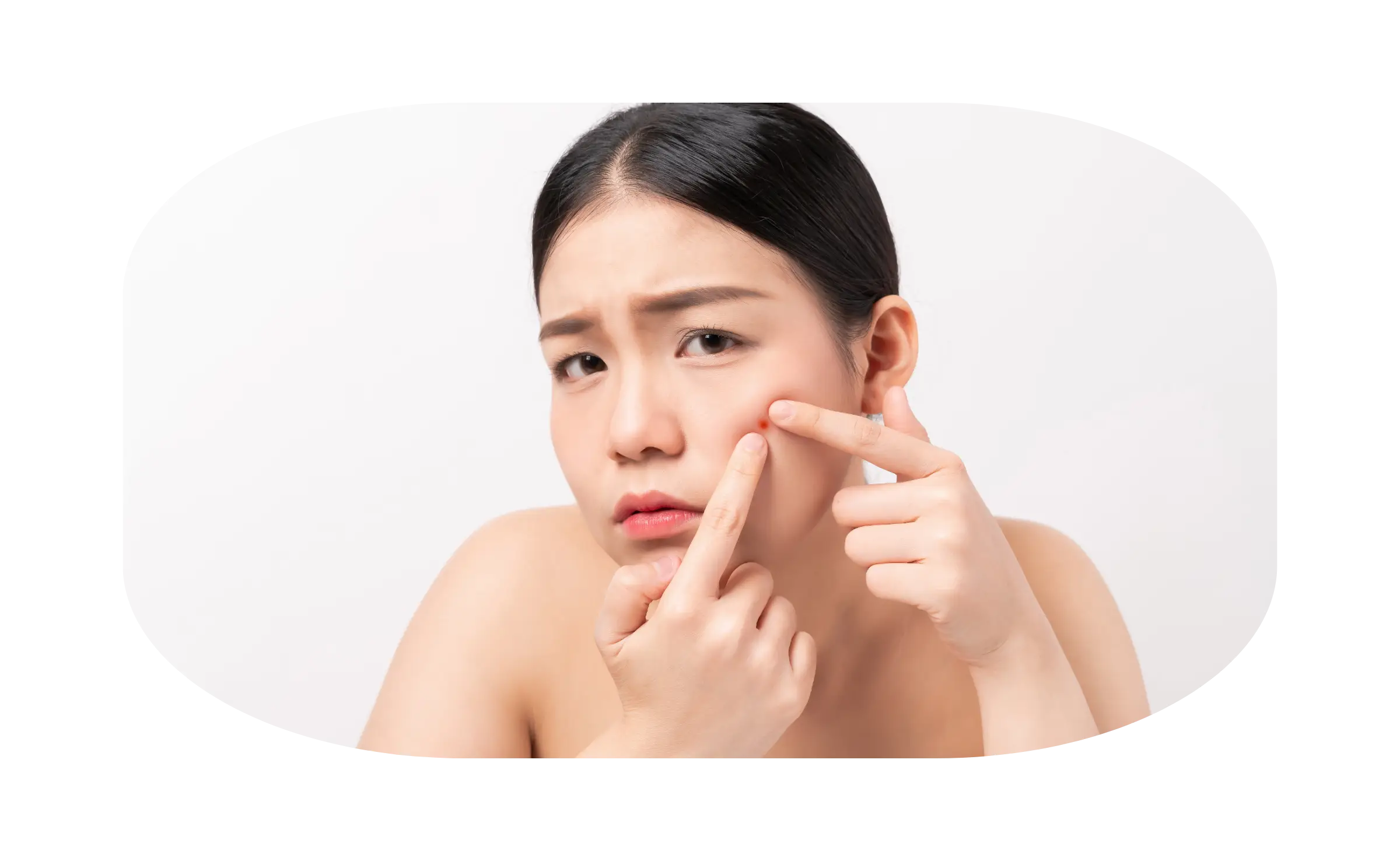 indikasi microneedling 2