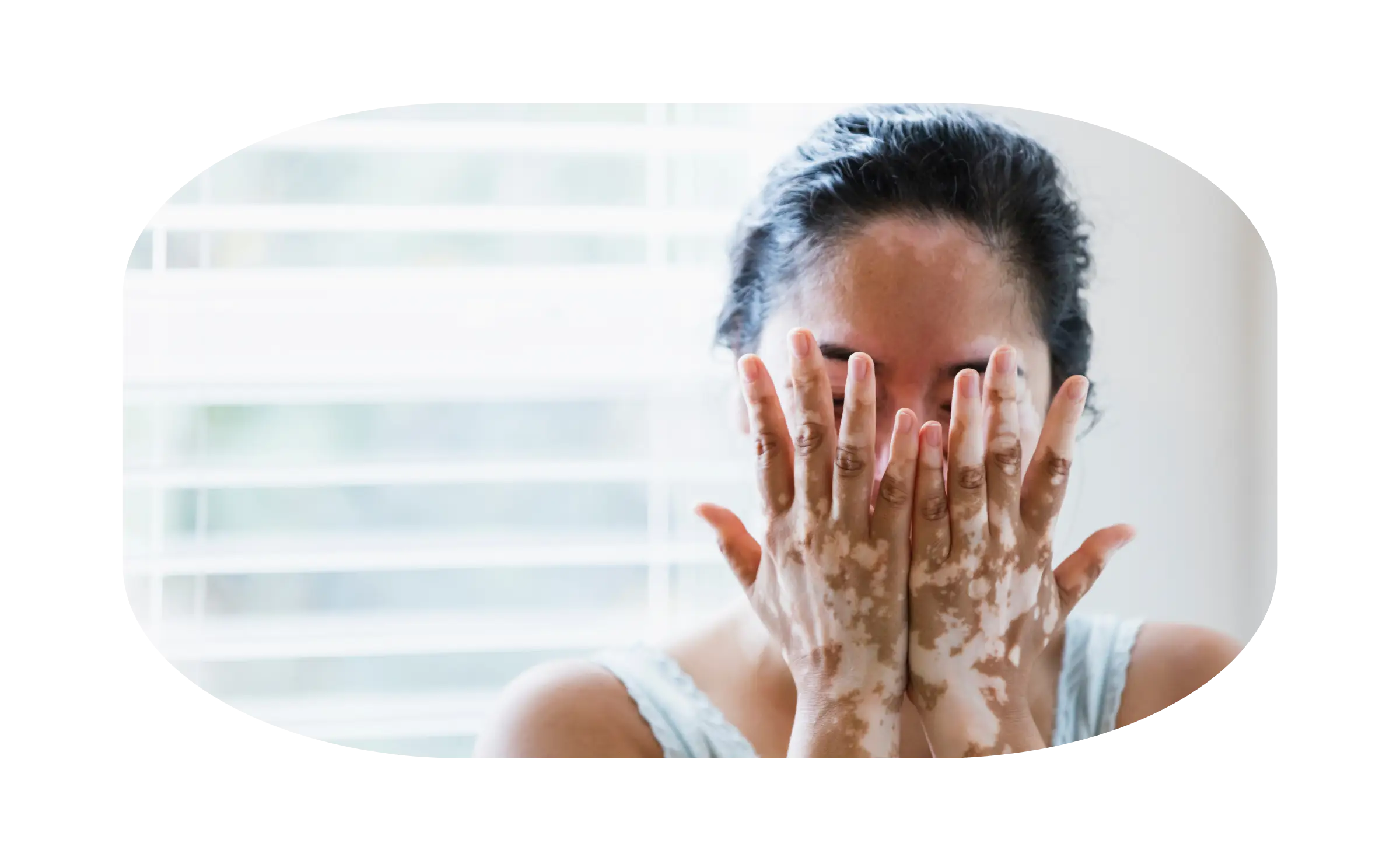 indikasi vitiligo 1