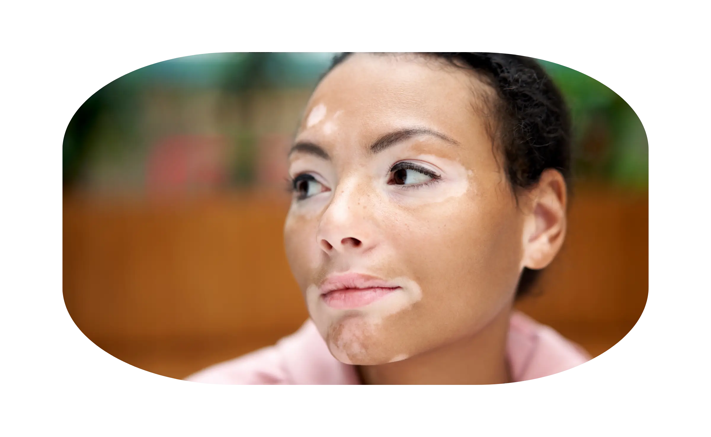 indikasi vitiligo 2
