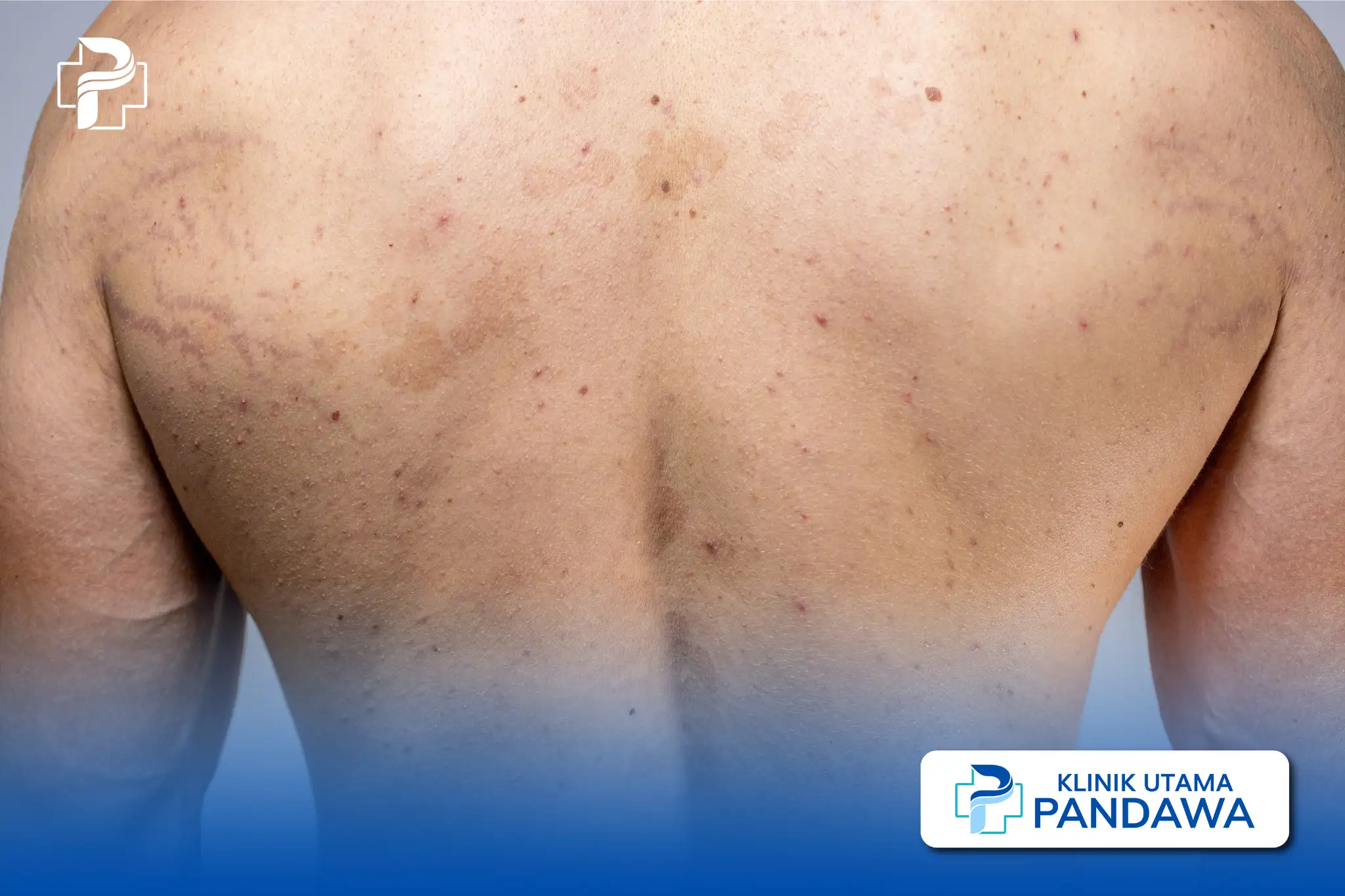 pityriasis rosea